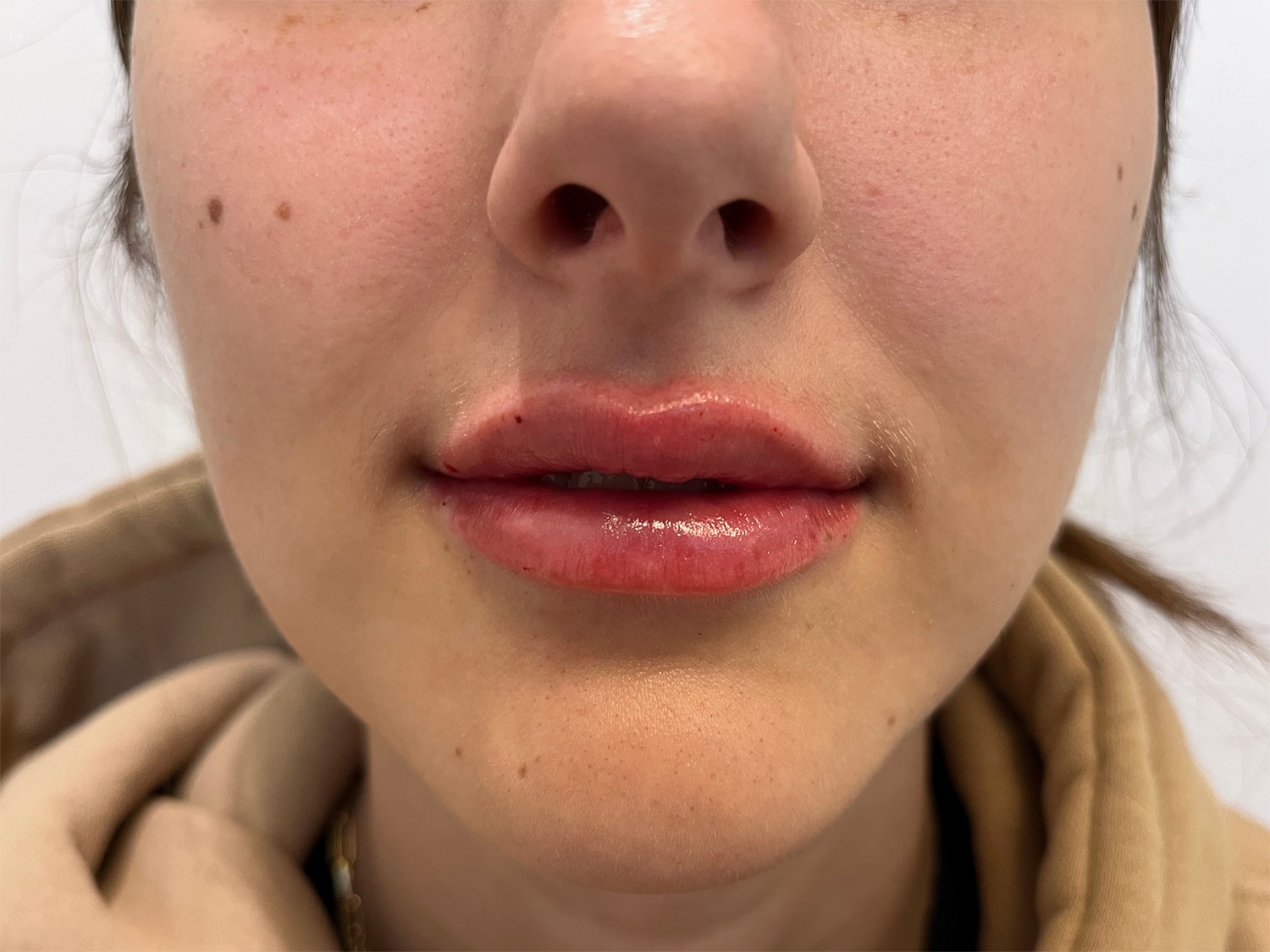 After Image: Dermal Filler for the Lips - front
