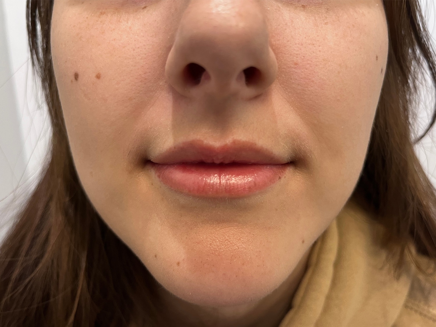 Before Image: Dermal Filler for the Lips - front