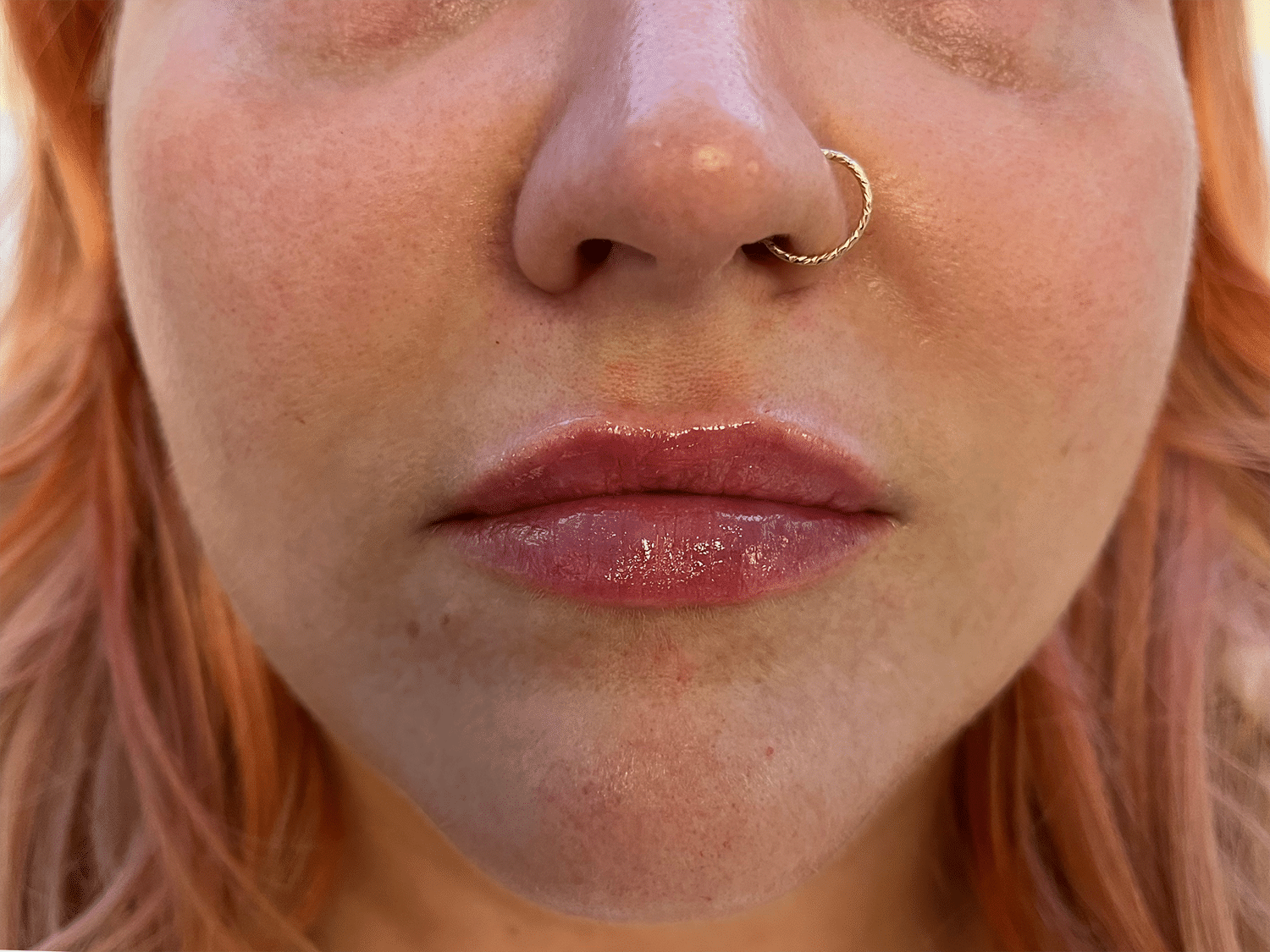 After Image: Dermal Filler for the Lips - front