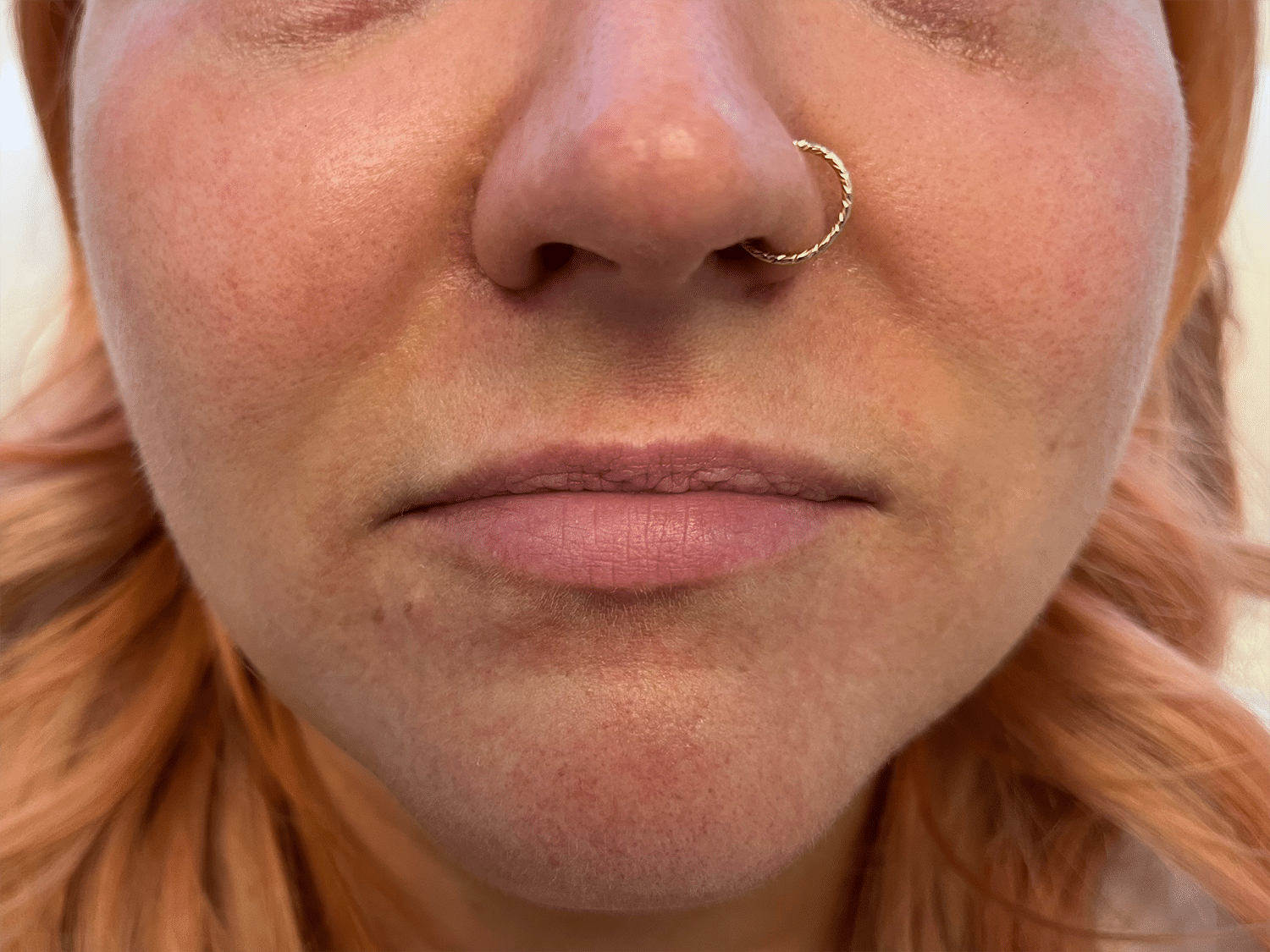 Before Image: Dermal Filler for the Lips - front