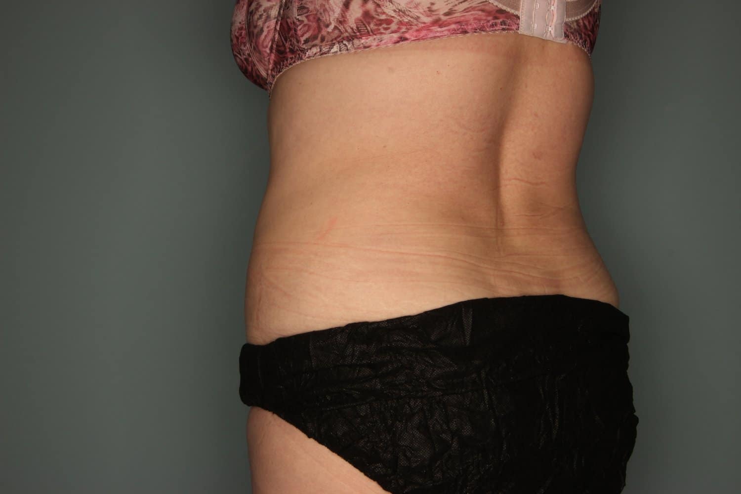 After Image: CoolSculpting to Flanks - left-back-oblique