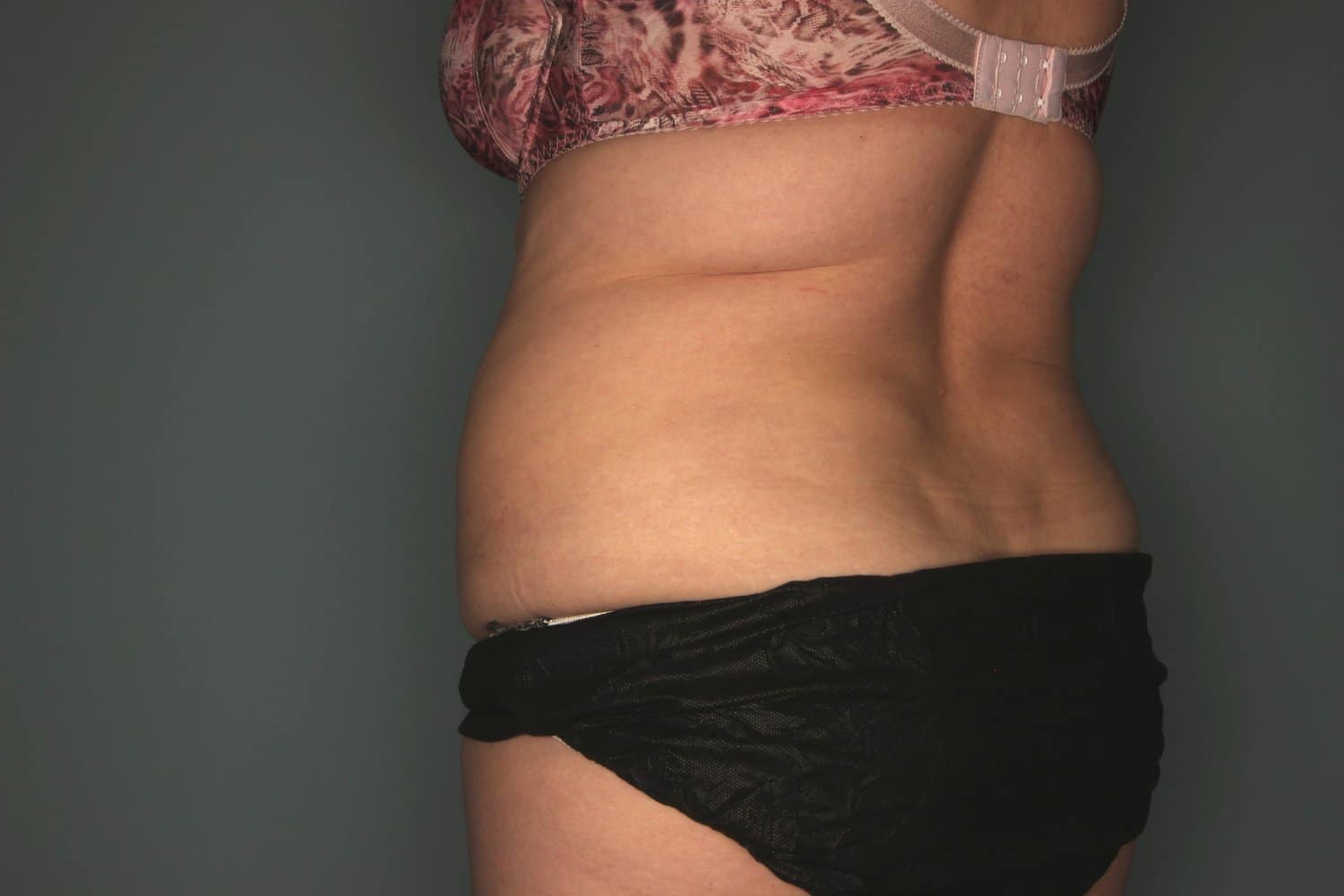 Before Image: CoolSculpting to Flanks - left-back-oblique