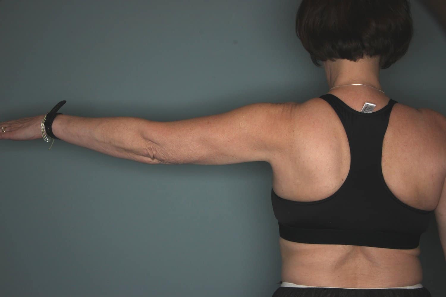 After Image: CoolSculpting to the Arms and Flanks - back