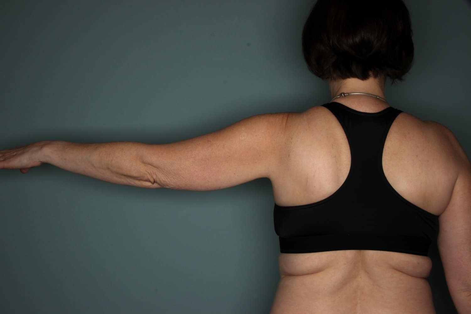 Before Image: CoolSculpting to the Arms and Flanks - back