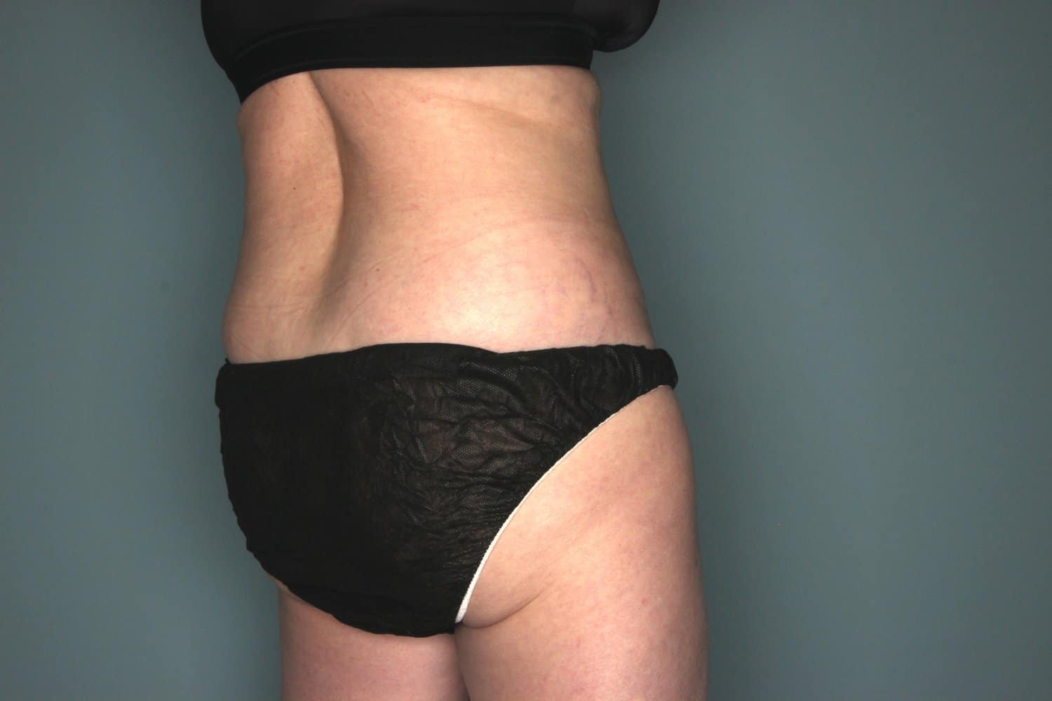 After Image: CoolSculpting to the Flanks and Hips - right-back-oblique