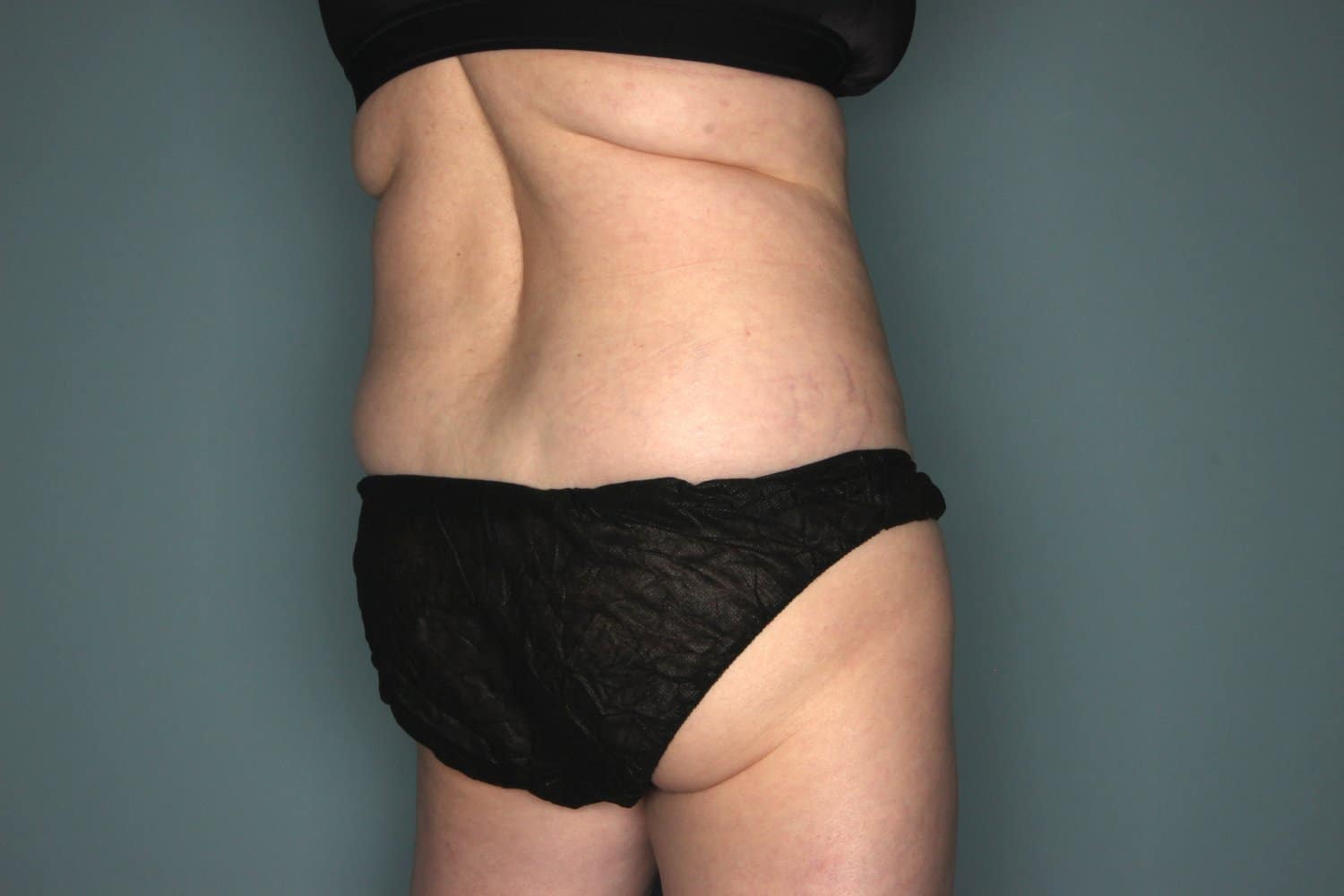 Before Image: CoolSculpting to the Flanks and Hips - right-back-oblique