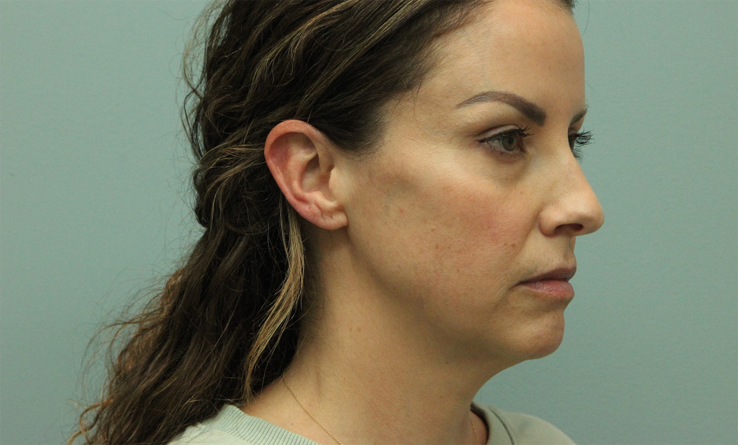 Before Image: Neck Lift - right-front-oblique