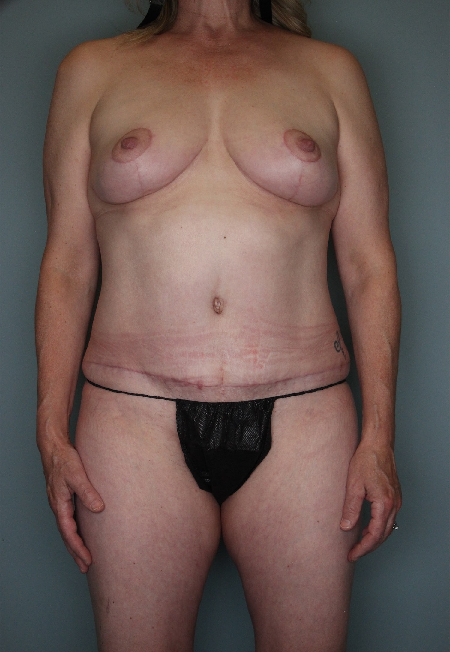 After Image: Mommy Makeover - front