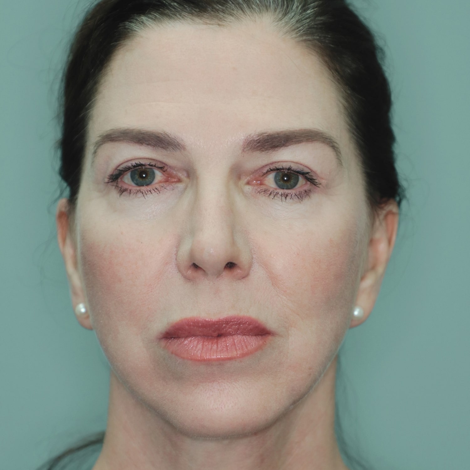 After Image: Corset Platysmaplasty - front