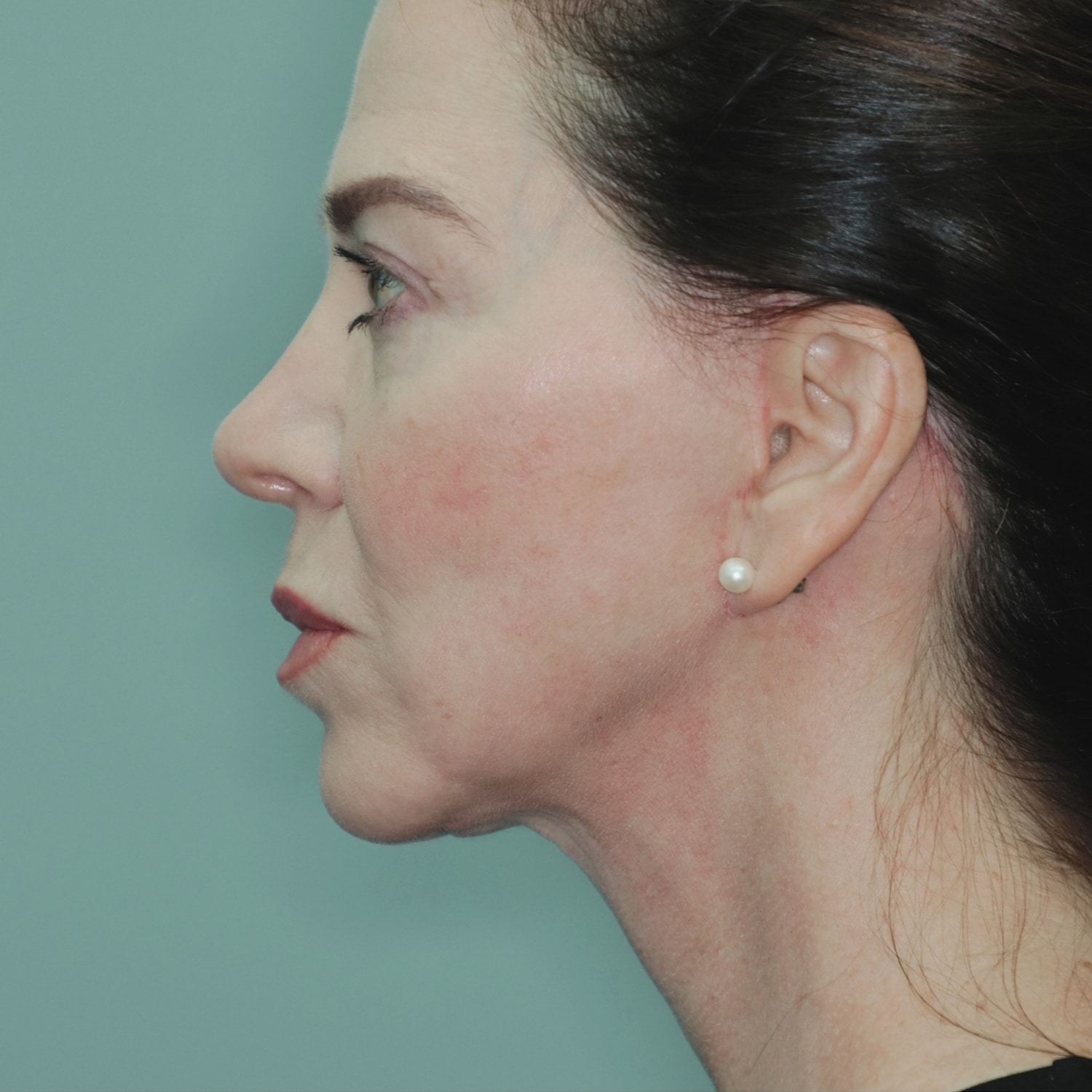 After Image: Facelift - left-side