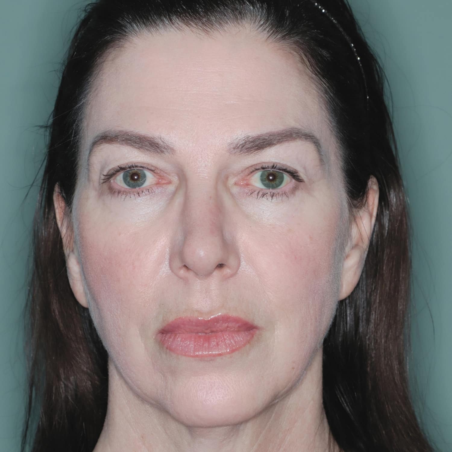 Before Image: Corset Platysmaplasty - front
