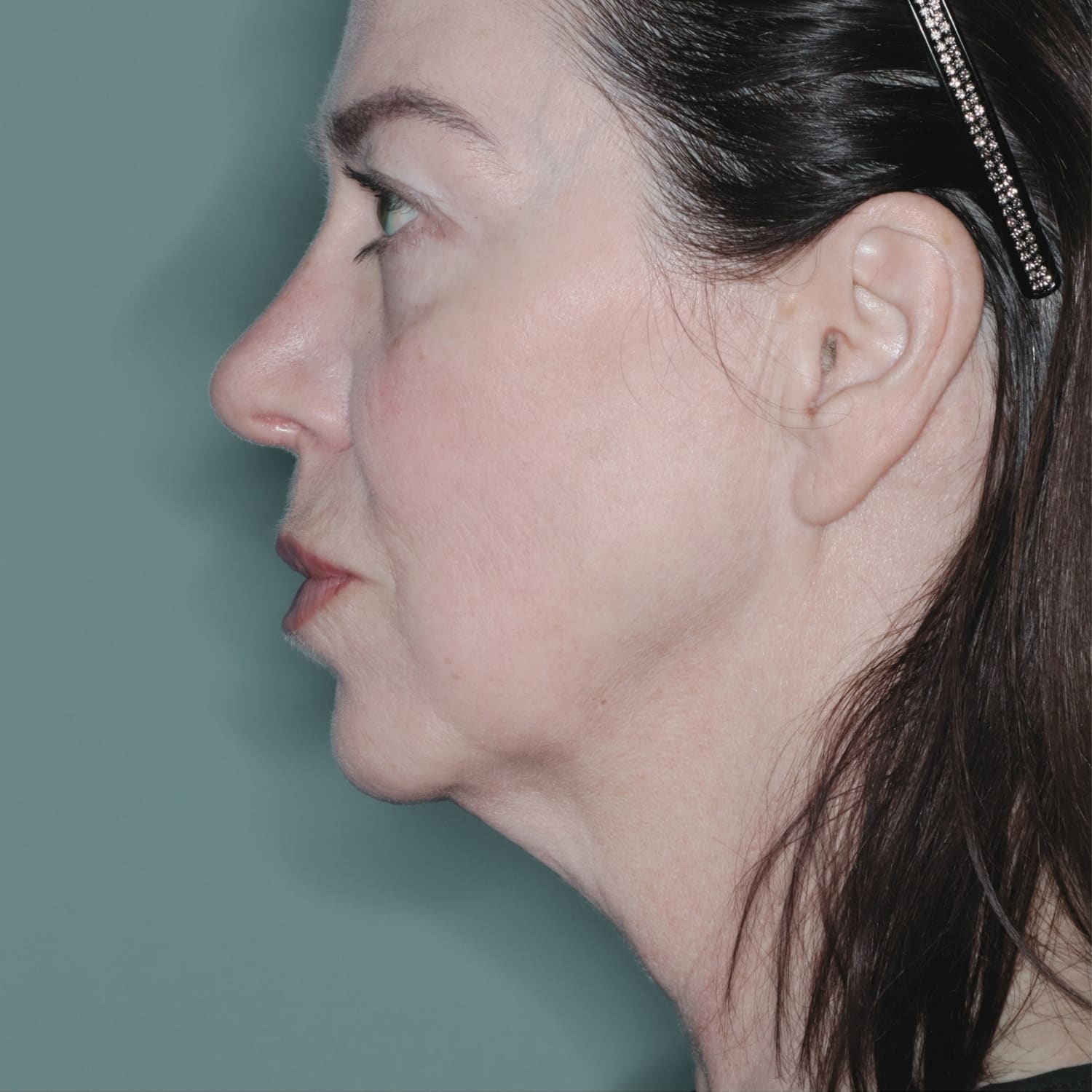 Before Image: Facelift - left-side