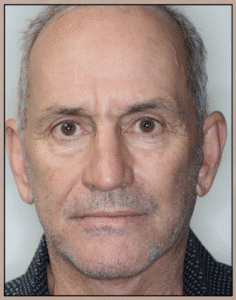 After Image: Facelift, Neck lift, and Corset Platysmaplasty