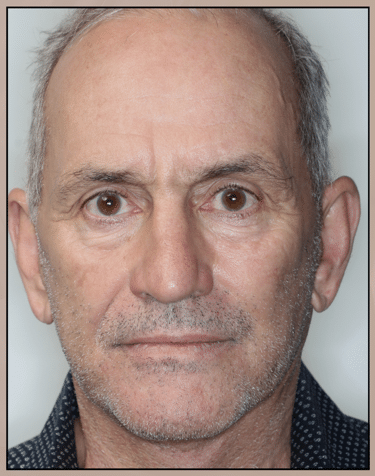 After Image: Facelift, Neck lift, and Corset Platysmaplasty - front