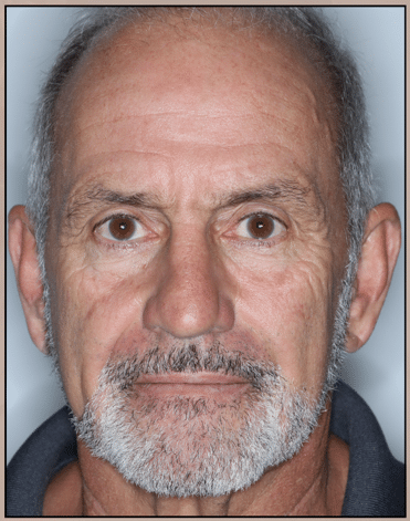 Before Image: Facelift, Neck lift, and Corset Platysmaplasty - front