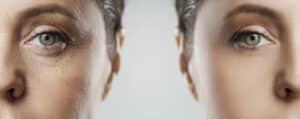 Before and after Botox wrinkle treatment