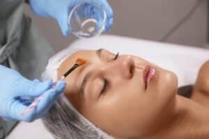 Chemical peel treatment for hyperpigmentation on the face.